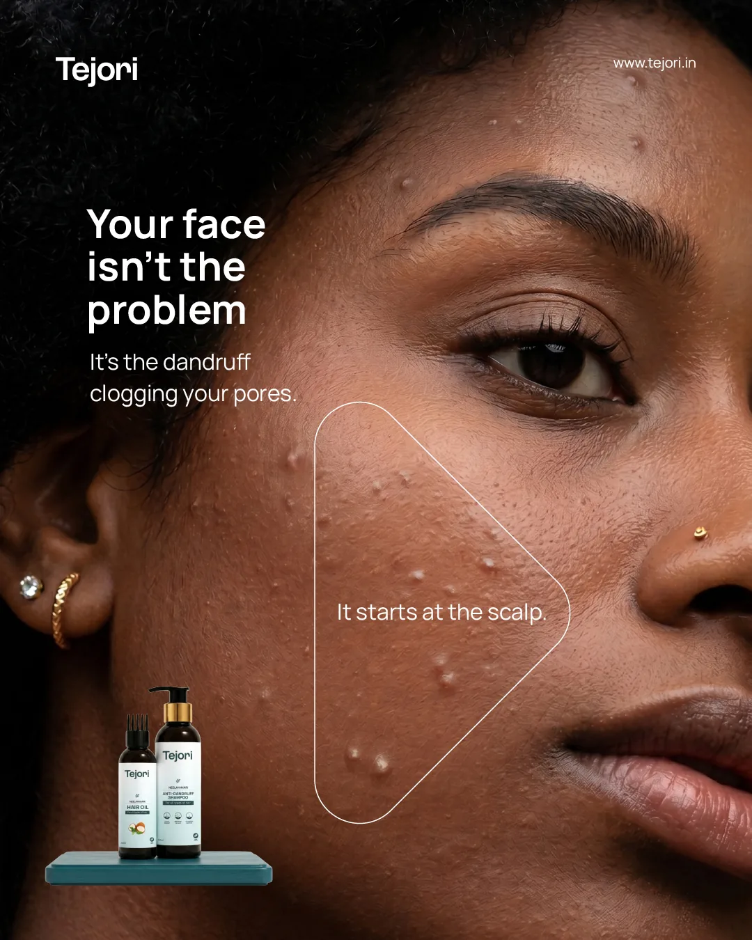 Tejori Instagram post 'Your face isn't the problem' and 'It's the dandruff clogging your pores.' over a close-up of a woman's face with breakouts, with 'It starts at the scalp.' in an outlined triangle on her cheek and the shampoo and hair oil on a teal plinth